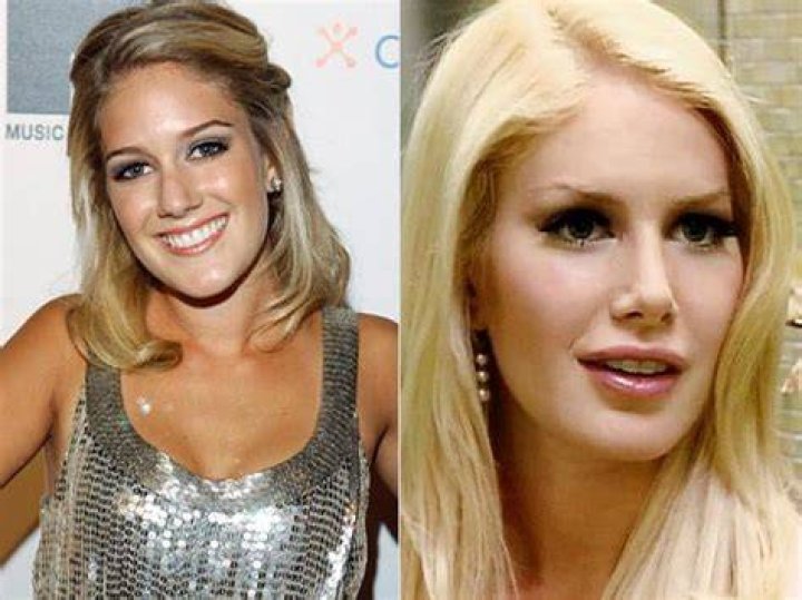Heidi Montag: A Transformation Story from Before to After Surgery