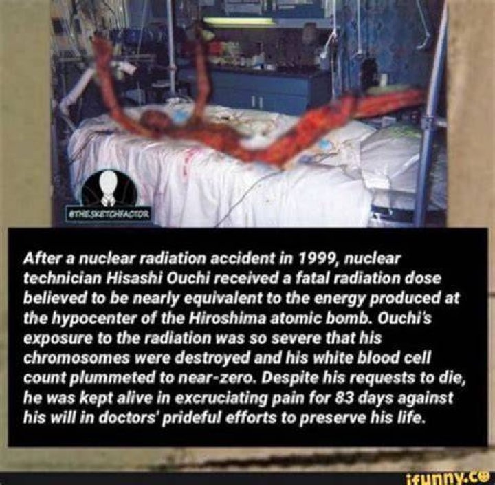 Hisashi Ouchi Radiation Photos: A Tragic Tale of Survival and Suffering
