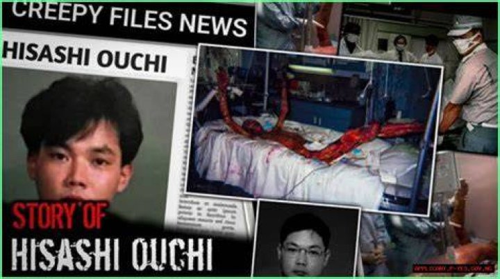 Hisashi Ouchi: The Real Photos from the Hospital and His Incredible Story