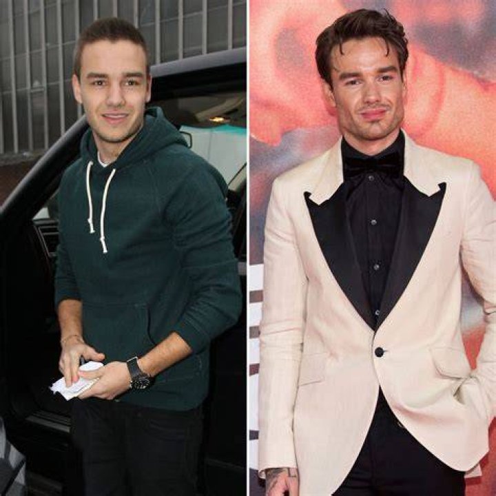 Liam Payne's Transformation: The Truth Behind His Plastic Surgery Rumors
