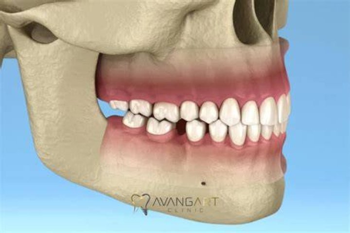 The Ultimate Guide to Baring of Teeth: Causes, Symptoms, and Treatment