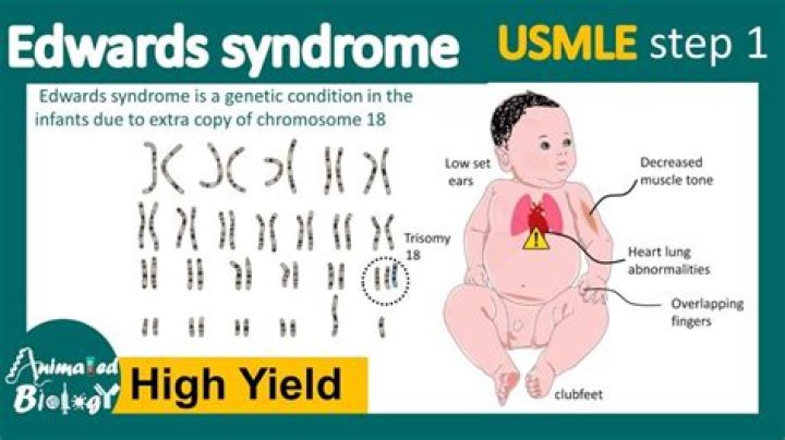 Understanding Edward Bluemel Syndrome: Causes, Symptoms, and Management