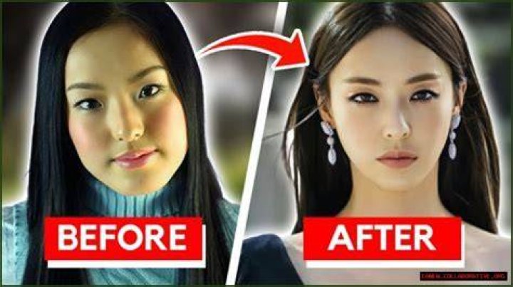 Unveiling the Journey: Minitinah Before Surgery