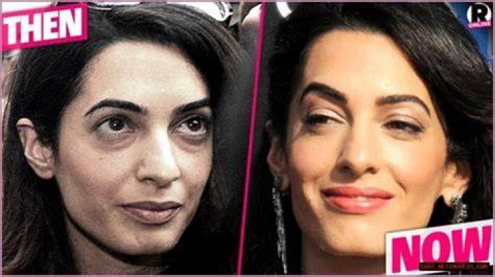 Unveiling the Truth Behind Amal Clooney's Surgery: A Closer Look