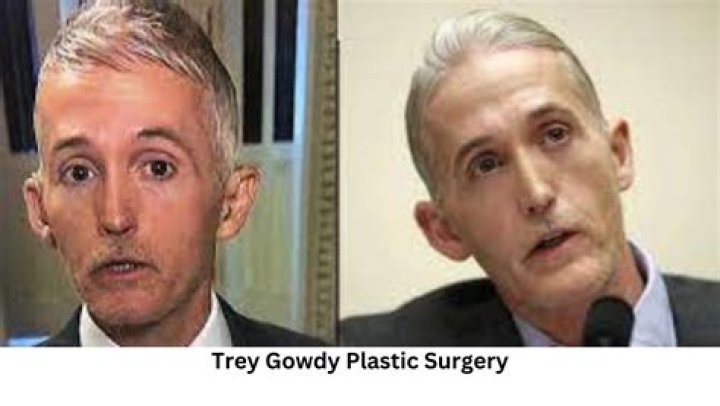 Unveiling the Truth Behind Trey Gowdy's Face Surgery